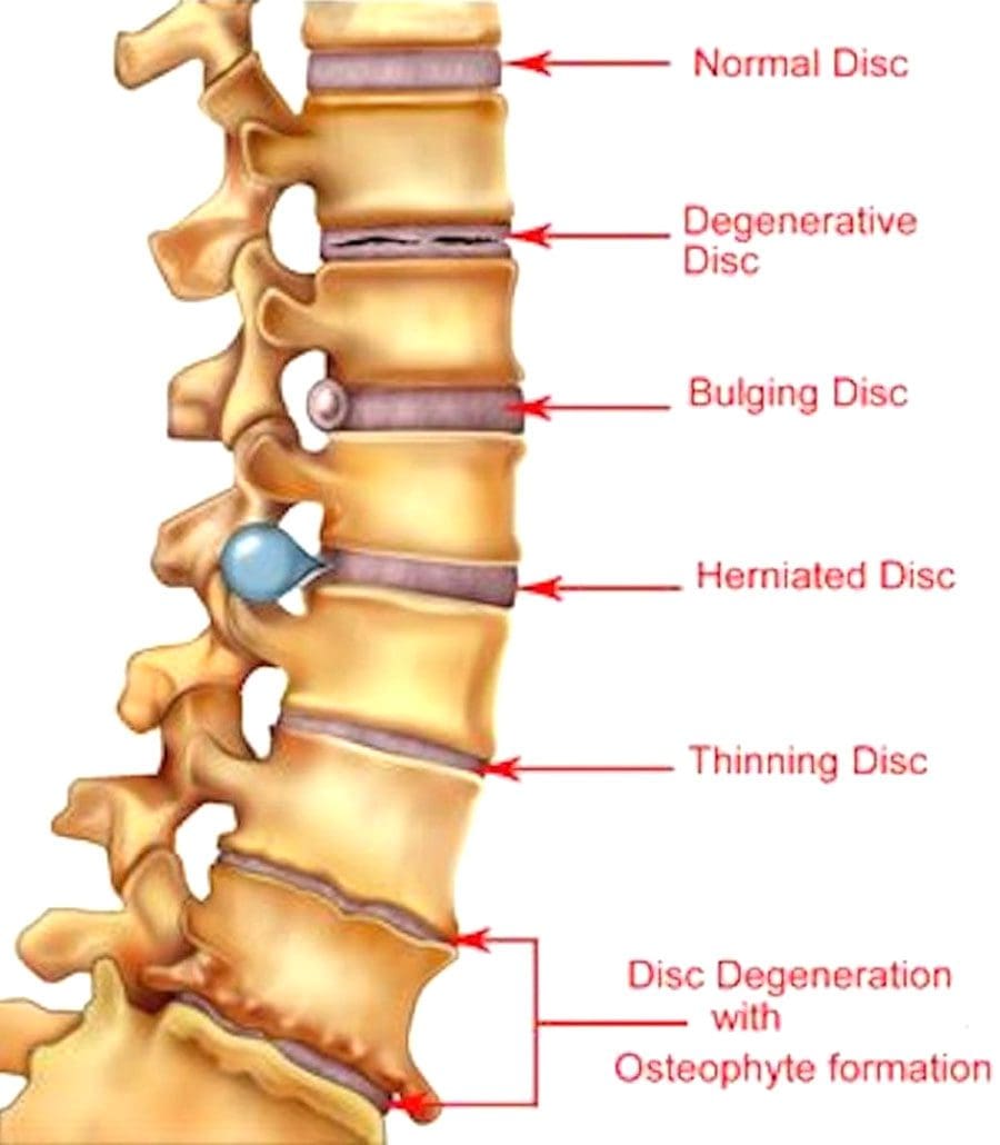 Condiciones de la Columna Vertebral y Diabetes