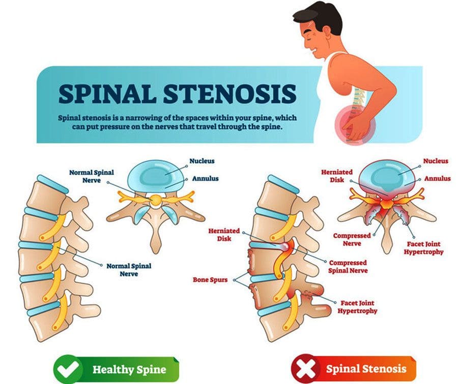 Claudication Muscle and Nerve Pain