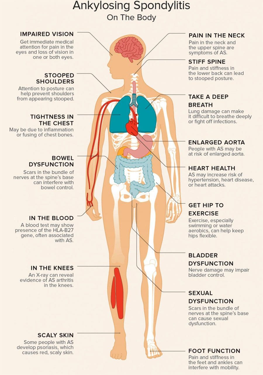 Ankylosing Spondylitis Chronic Fatigue