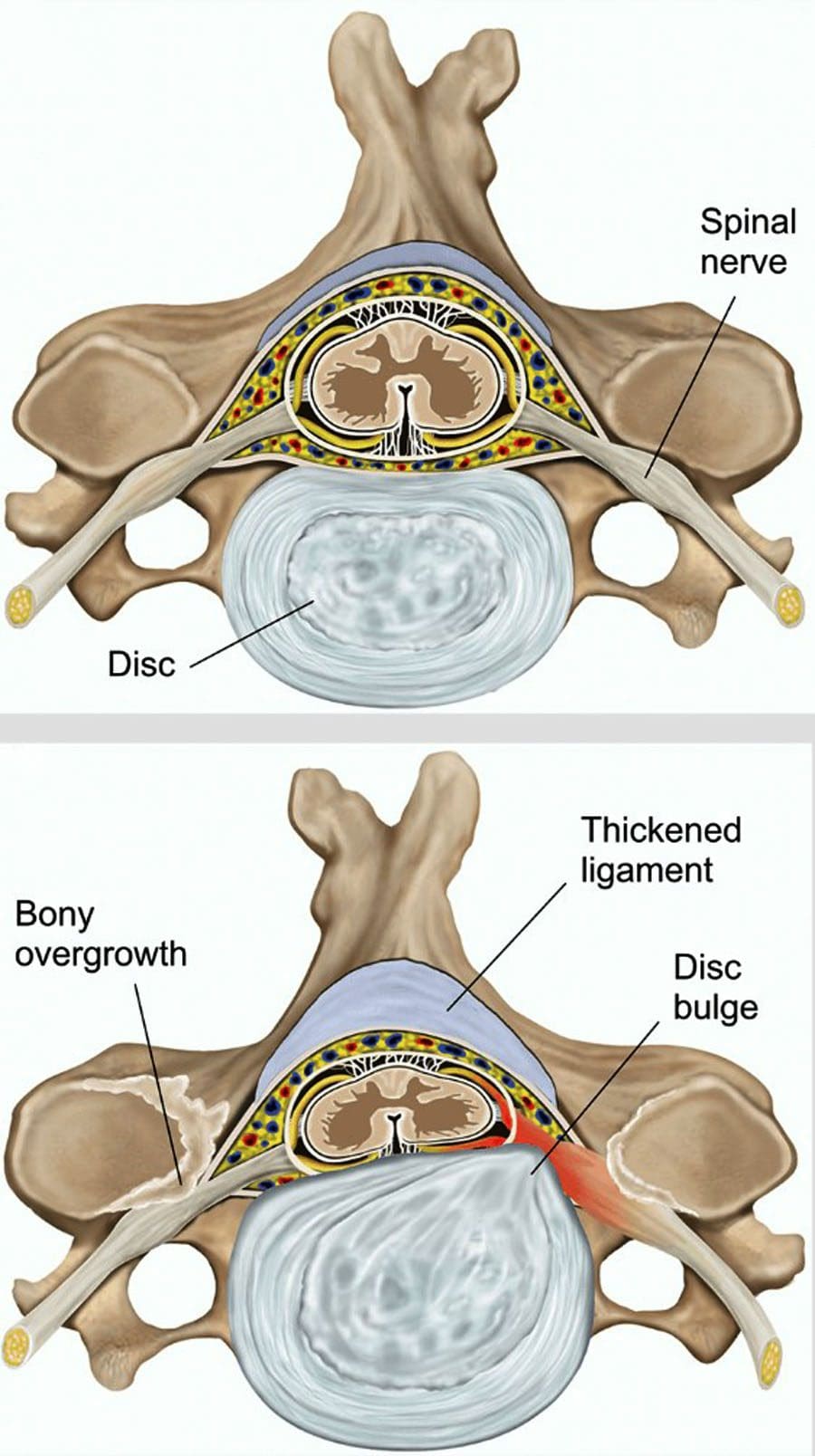 Talooyinka Dhakhaatiirta: Stenosis laf-dhabarka ilmo-galeenka