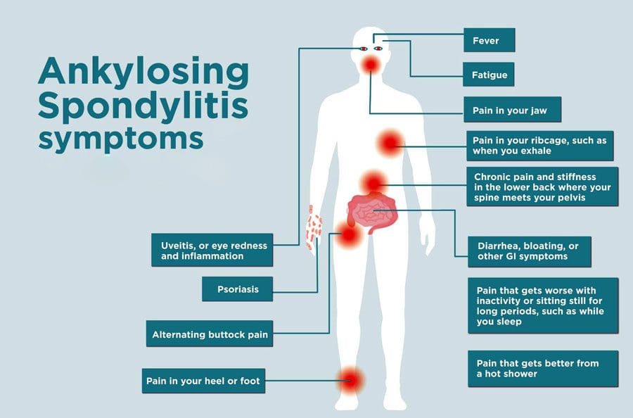 Skin Disorders From Ankylosing Spondylitis