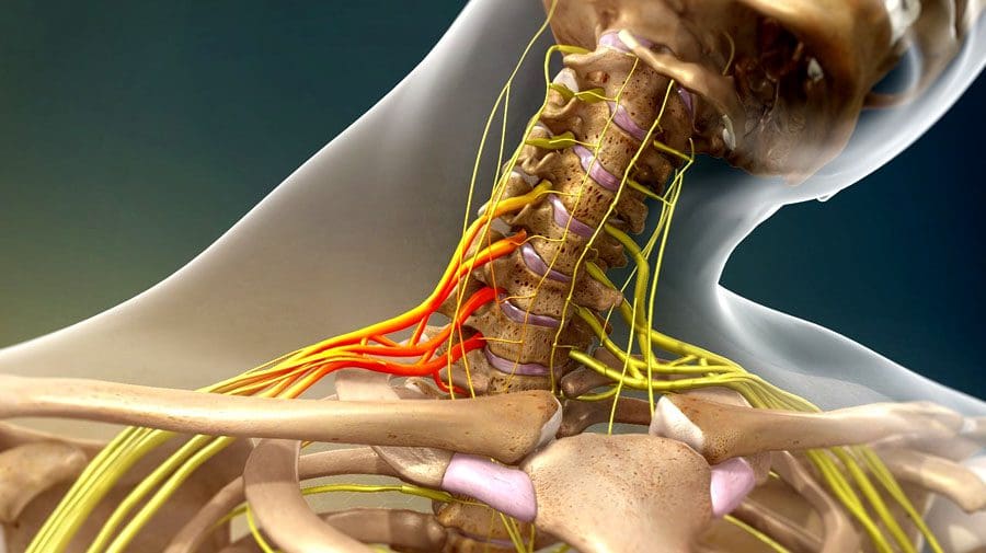 Dhaawaca Dareemaha ee Brachial Plexus Chiropractor