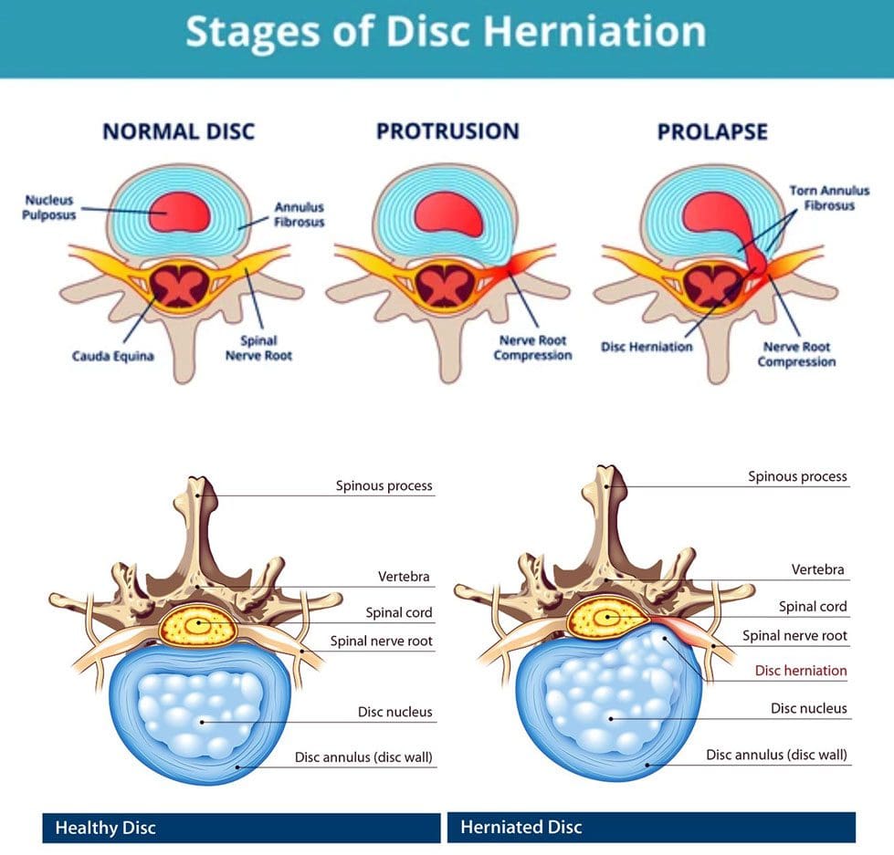 Disc Herniation: Symptoms, Diagnosis, How To Treat - MSK Health and  Performance Clinics