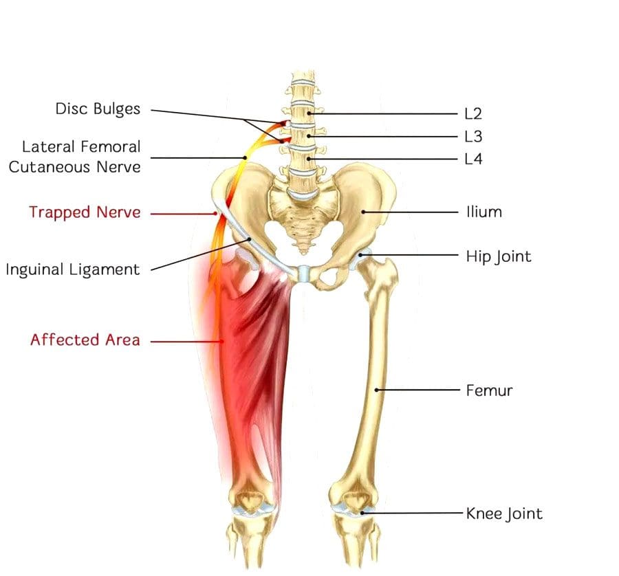 Pinched Nerve Sa Hip Chiropractor