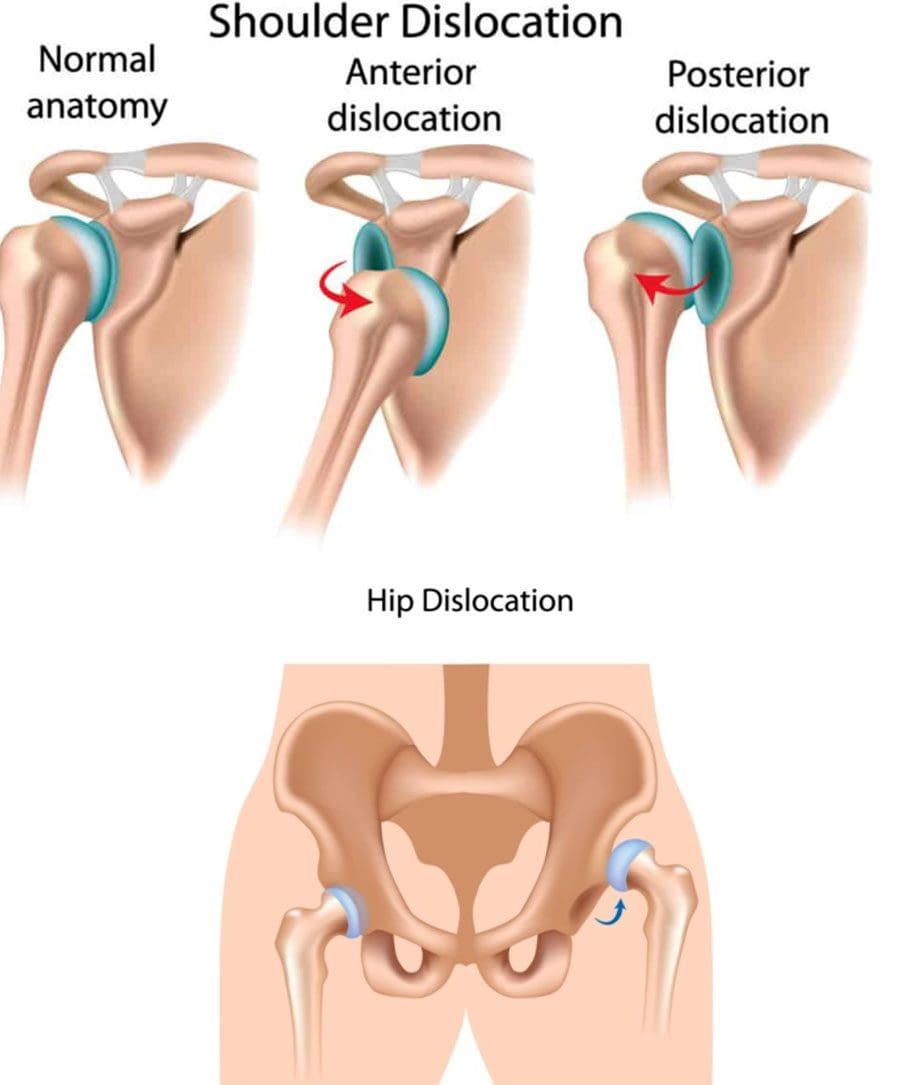 Quiropráctico de dislocación articular