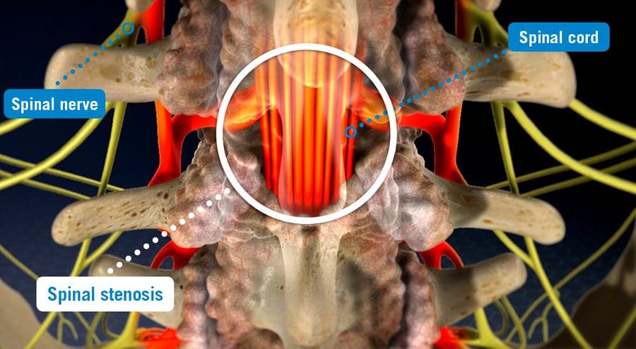 Resonancia magnética de estenosis espinal: quiropráctico médico de lesiones