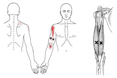 The Biceps Being Affected By Trigger Points - El Paso, TX Health Coach  Clinic