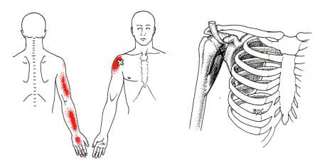 Upper Back, Shoulder, and Arm  The Trigger Point & Referred Pain