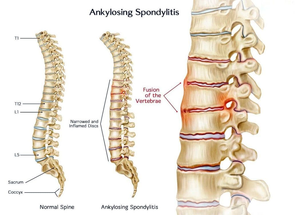 Анкилозирующий спондилит что это такое фото