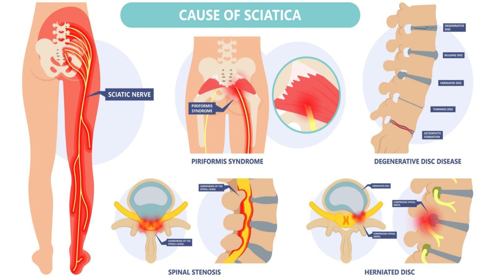 Quiropráctico de ciática aguda, crónica, alternante y bilateral