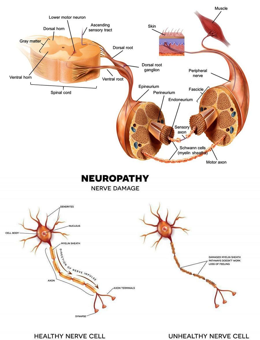 Bibajẹ Nafu Awọn aami aisan Chiropractor