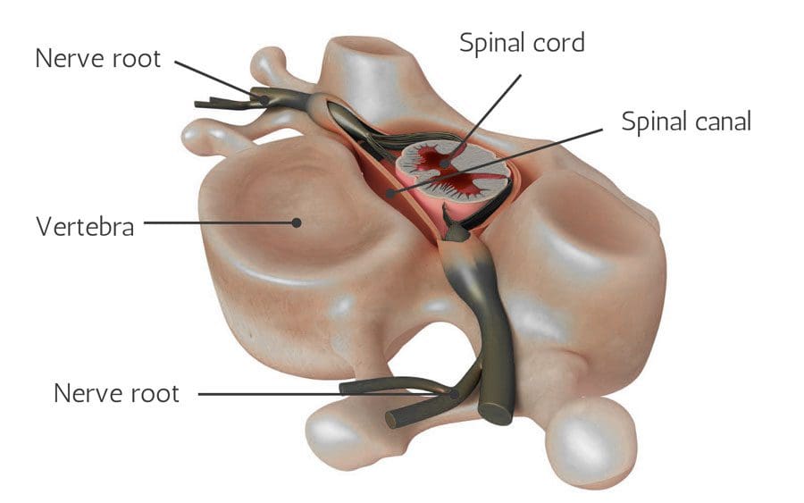 I-Chiropractor eyonzakeleyo, eyonzakeleyo yeNerve Roots