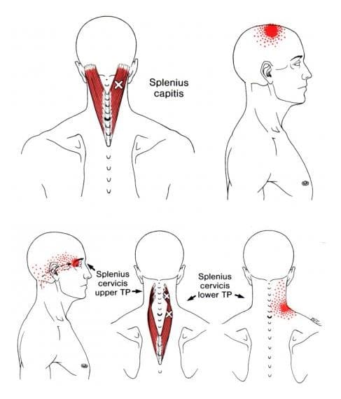 Puntos Gatillo Que Afectan El Cuello Y Los M sculos Esplenios EP 