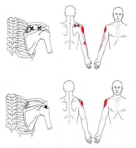 supraspinatus trigger points