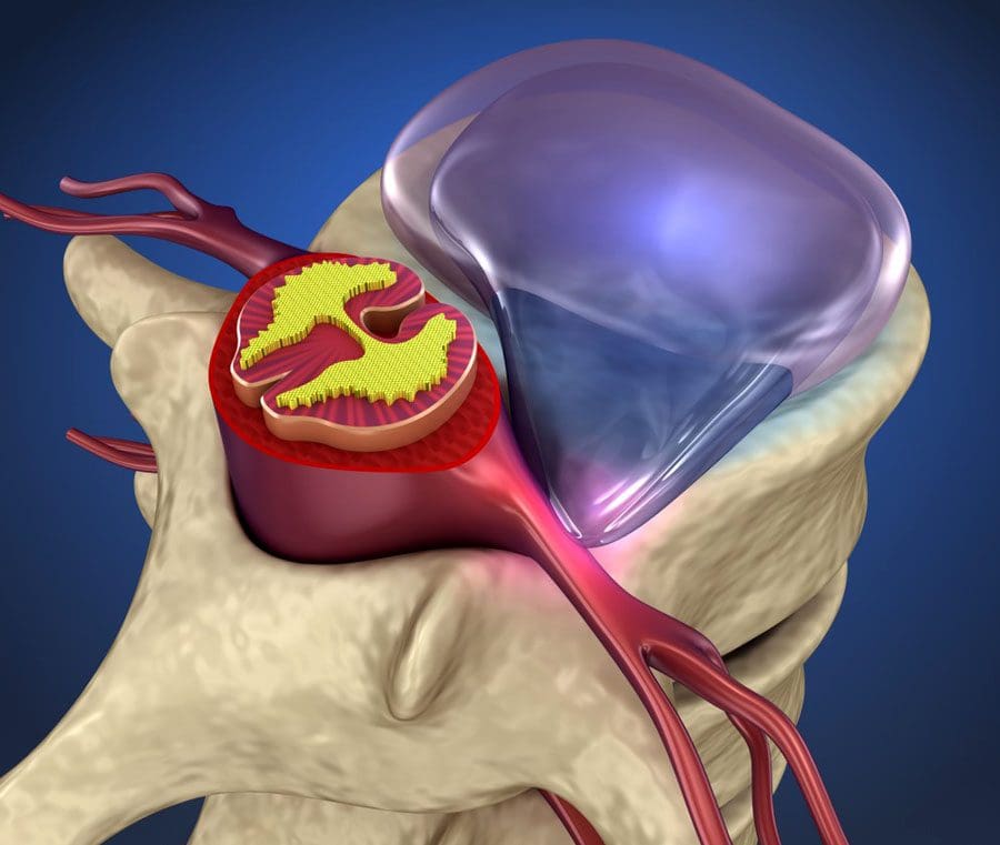 Herniated Disk in the Lower Back - OrthoInfo - AAOS