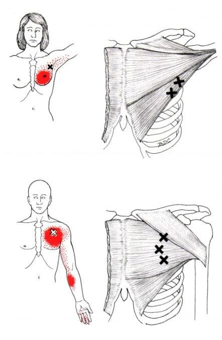 Trigger Point Therapy - Treating Pectoralis Major, Pectoralis Muscles,  Shoulder and more