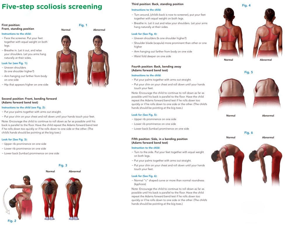 Scoliosis Diagnosis: The Adams Forward Bend Test 