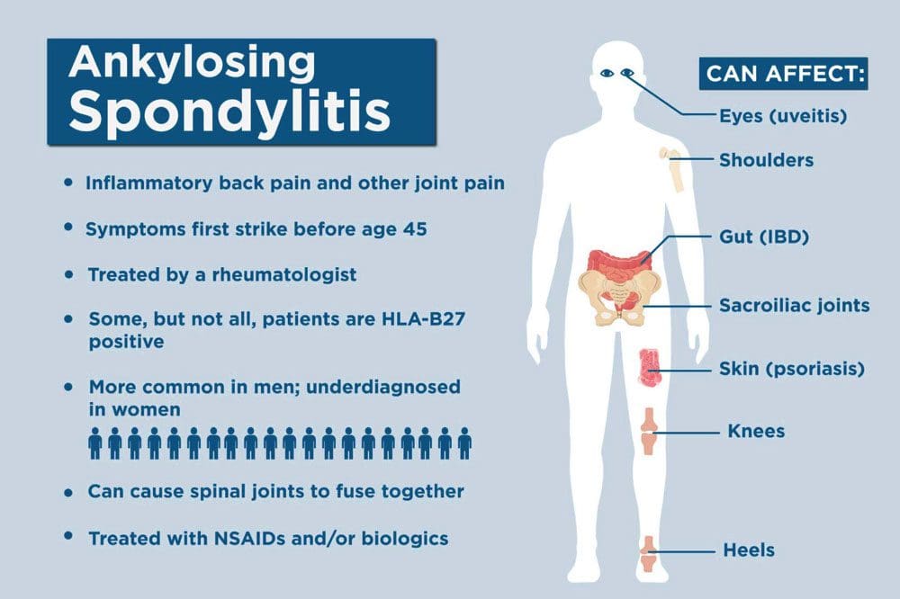 Ankylosing Spondylitis සඳහා ජීව විද්‍යාව: චිරොක්‍රැක්ටික් සායනය