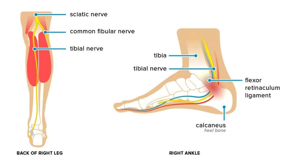 Sciatica: MedlinePlus Medical Encyclopedia