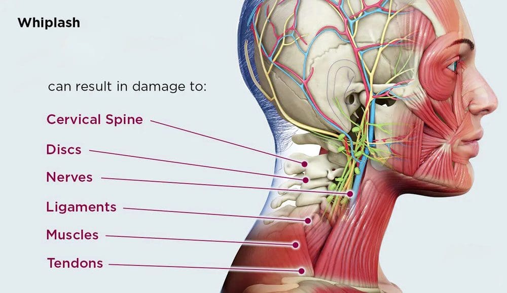 WAD Whiplash Distúrbios Associados: Lesões Quiropraxia Médica