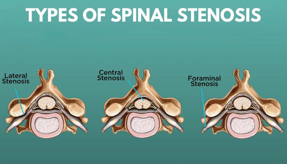 Stenoza Recess Lateral: Birîndar Chiropractic Medical