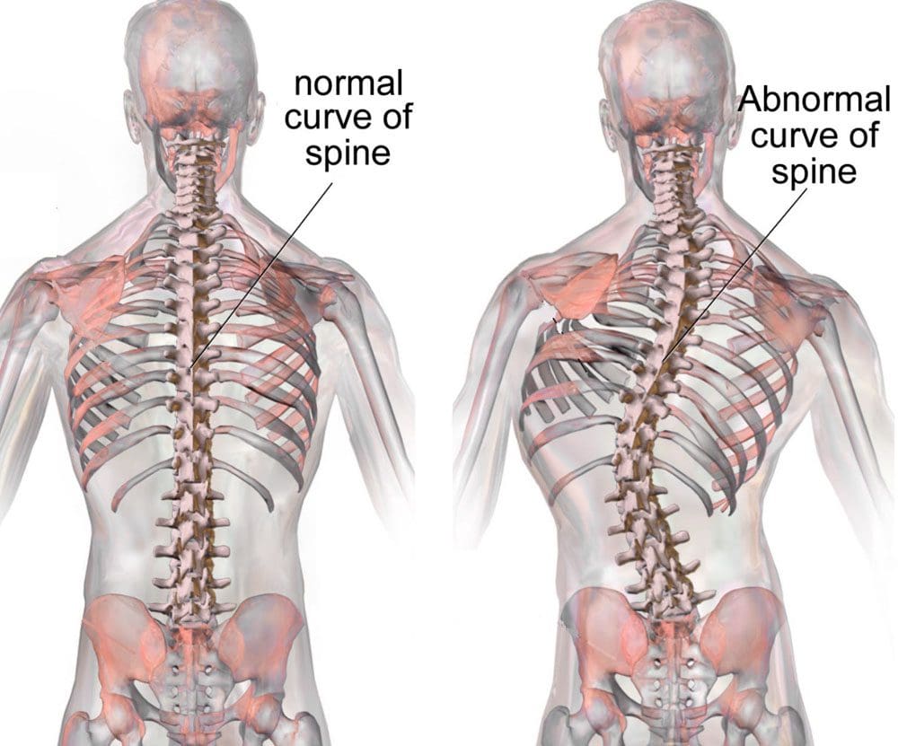 Scoliosis Idiopathic: Tîma Chiropractic ya EP