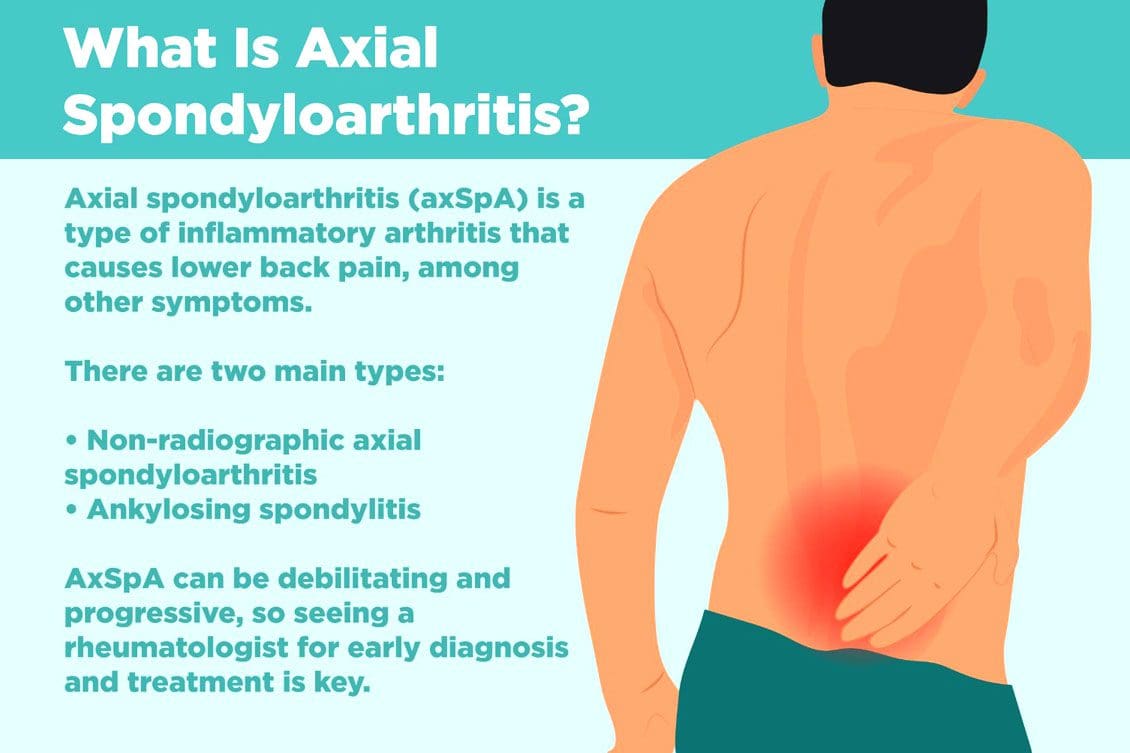 Spondyloarthritis Axial Aan Radiographic ahayn: EPs Kooxda Chiropractic