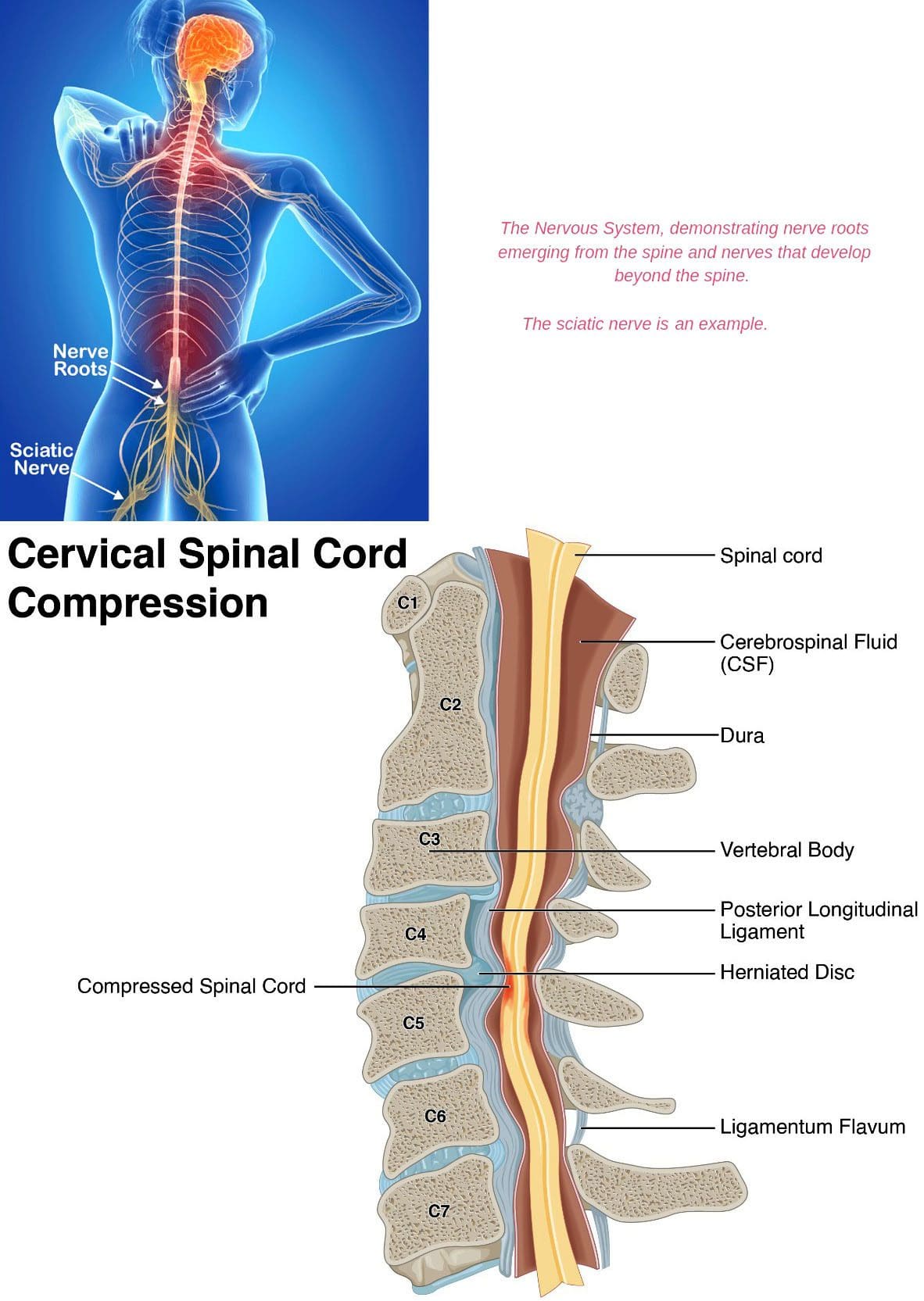 Pinched Nerve Treatment in South Florida