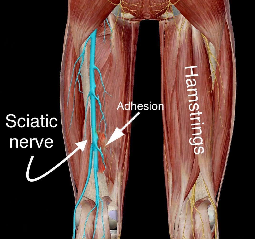 Trapped Sciatic Nerve In or Around Hamstrings: Chiropractic Clinic