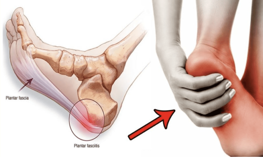 Undgå opblussen af ​​plantar fasciitis med disse tips