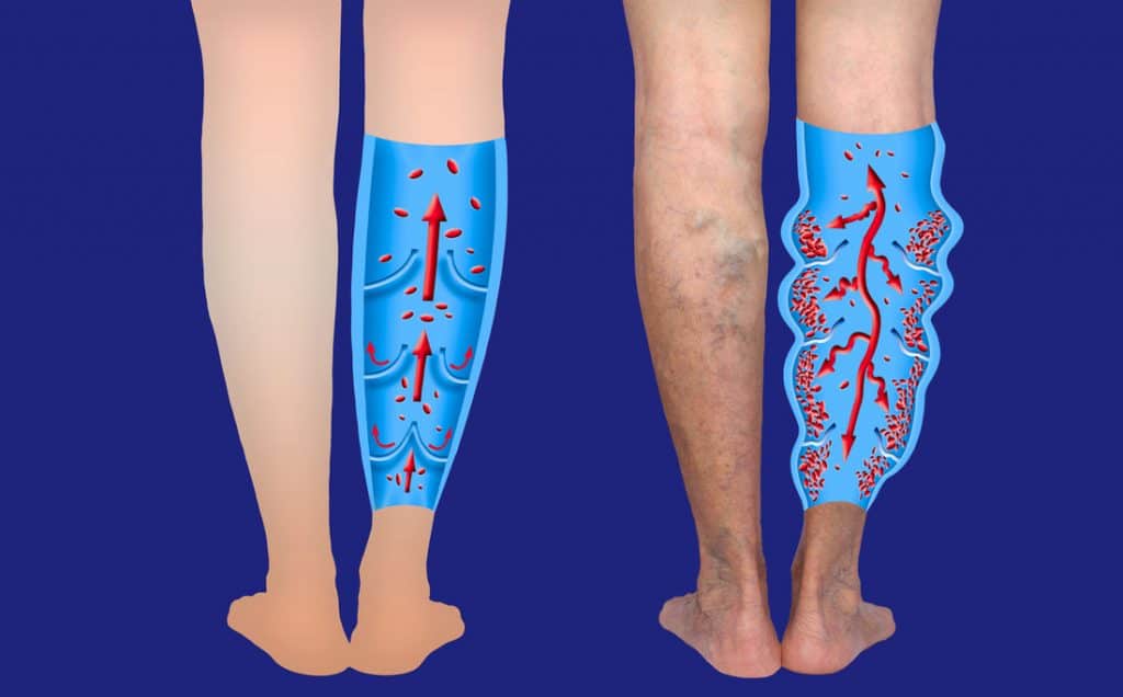 What You Need To Know About Venous Insufficiency Chiropractic