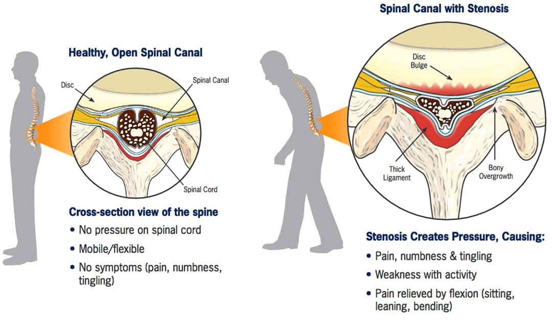 Understanding Spinal Stenosis: Physical Therapy Explained