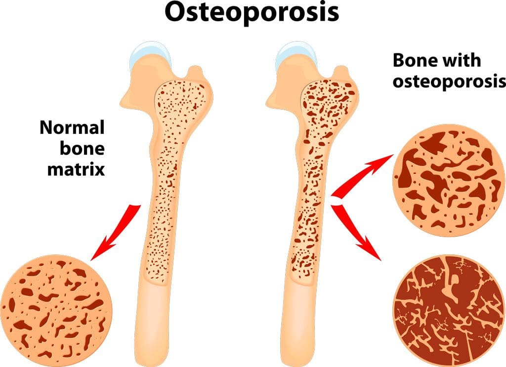 Increasing Bone Strength: Protecting Against Fractures