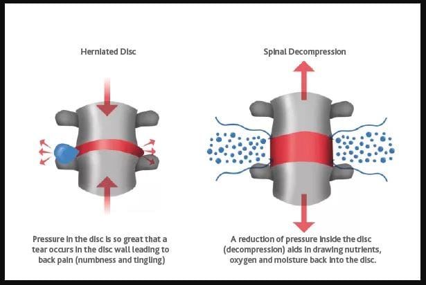 Herniated Disc Protocols Implemented For Spinal Decompression Integrative Wellness Podcast