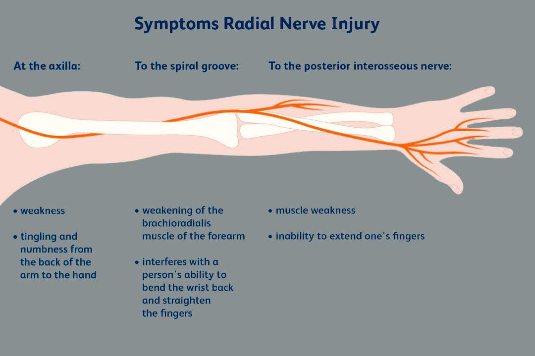 Radial Nerve: Peripheral Upper Extremity