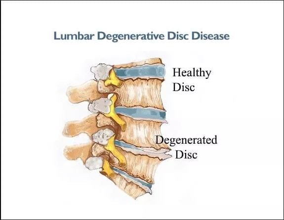 Lumbar Disc Degeneration Relieved With Decompression - EP Wellness