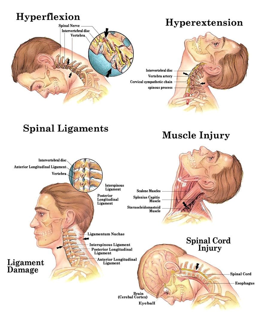 Aceleración cervical - Desaceleración - CAD