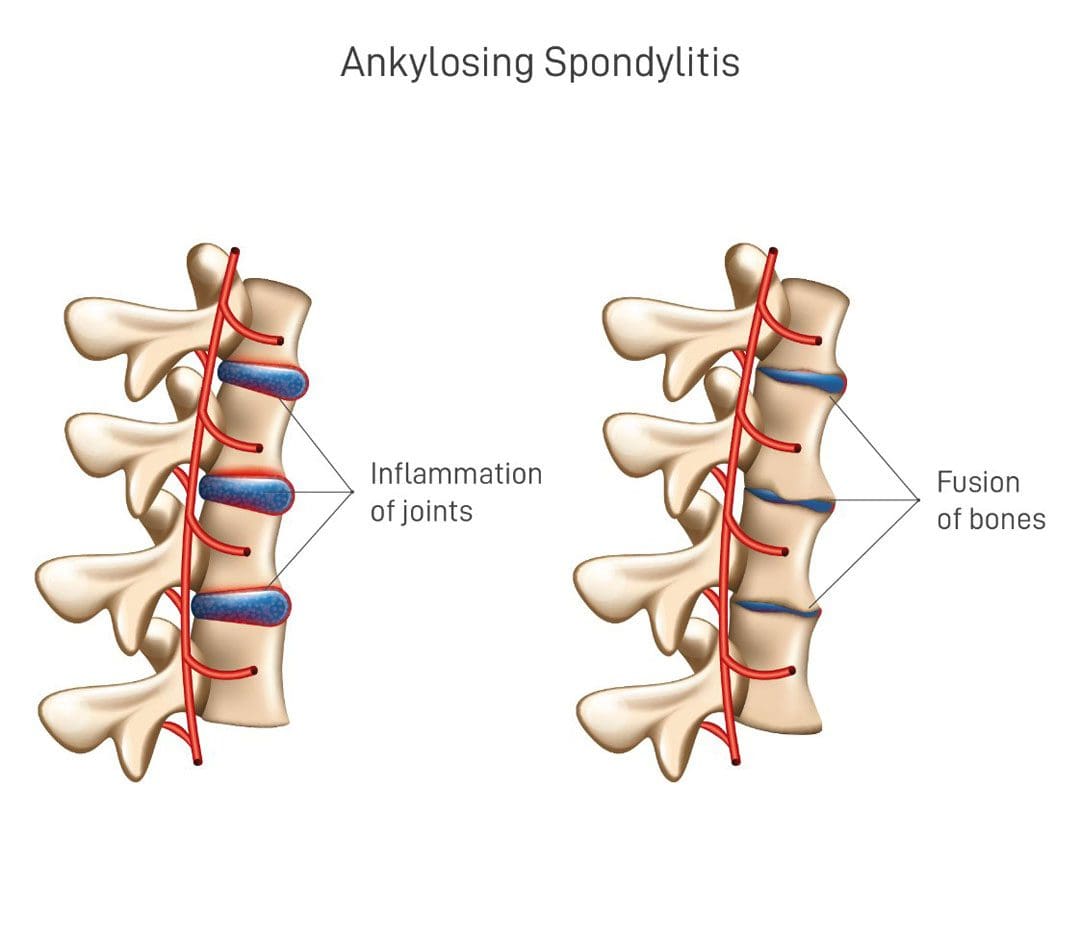 Ankylosing Spondylitis: Improve Your Posture With These Tips