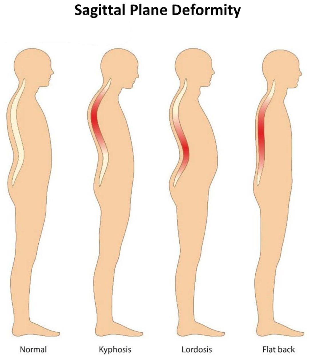 ස්ථාවර Sagittal අසමතුලිතතාවය