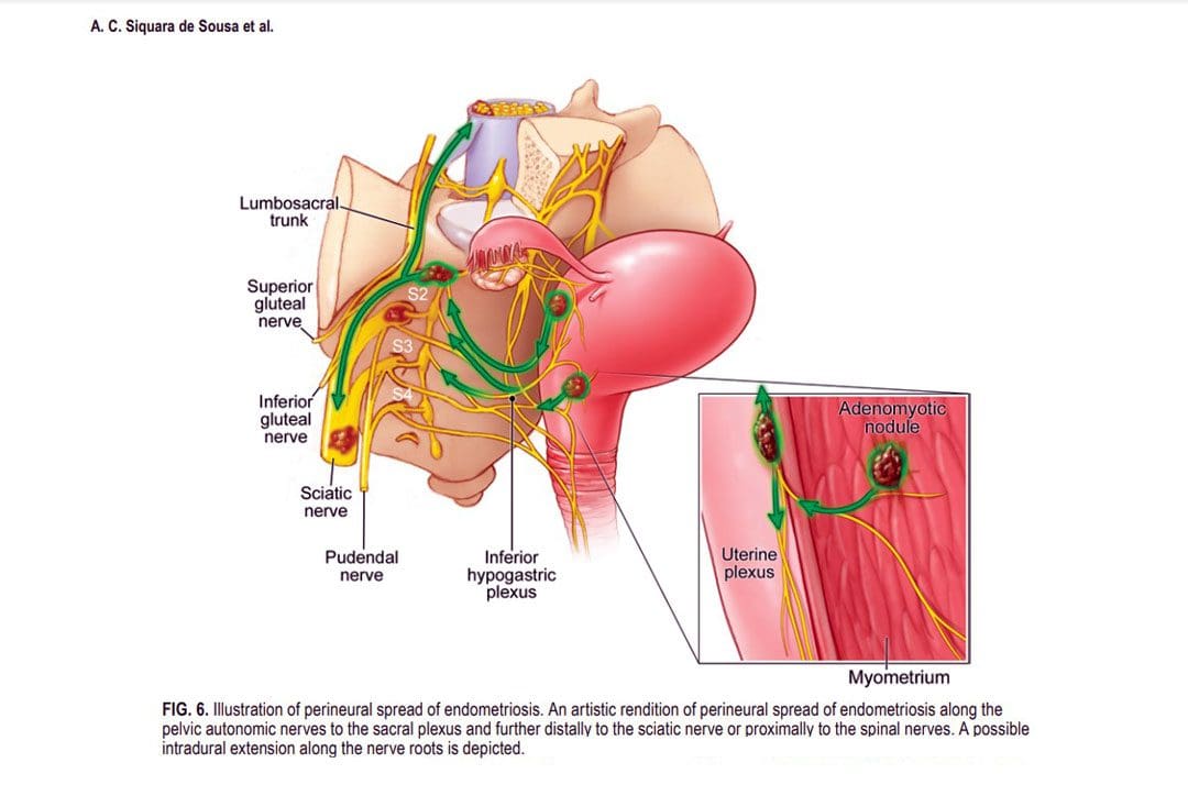 Iskias endometriose