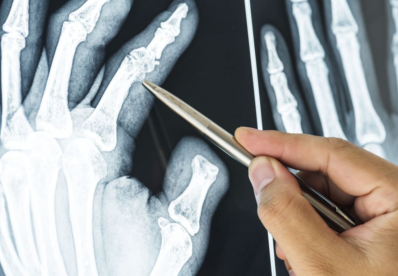 Managing Finger Injuries: From Minor to Severe