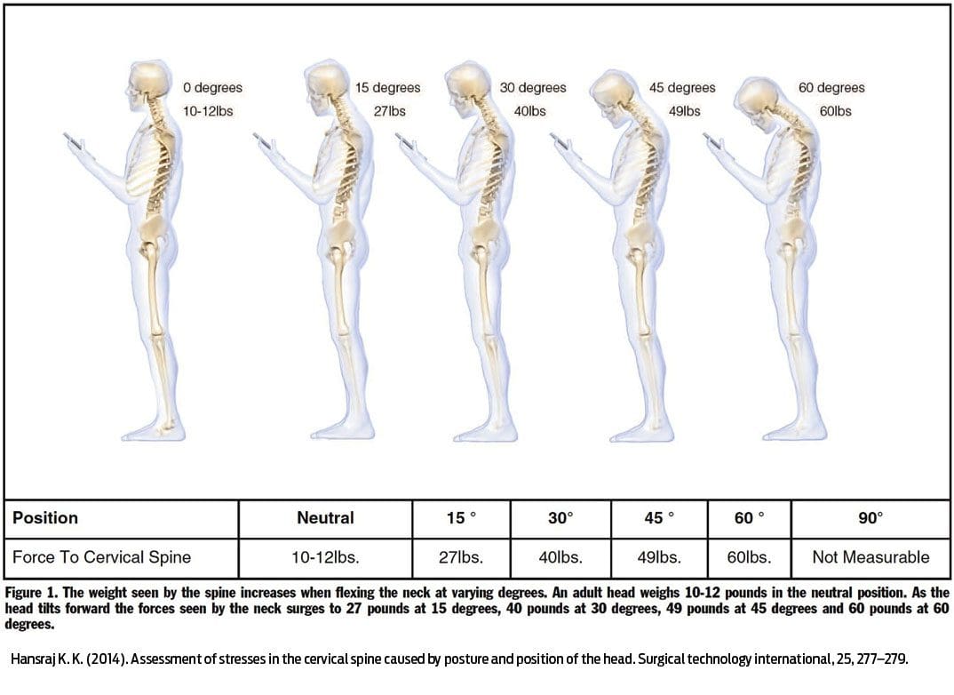 Understanding Forward Head Posture: Guide to Posture Correction