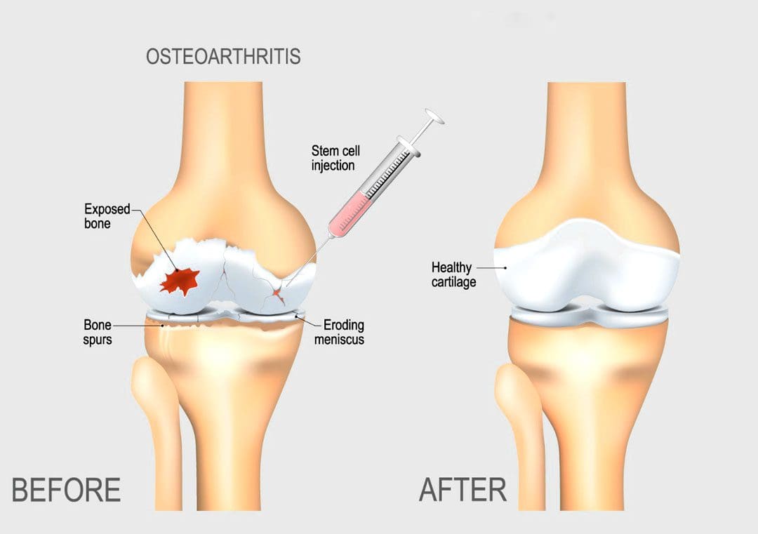 Regenerative Cells for Arthritis: What You Should Know