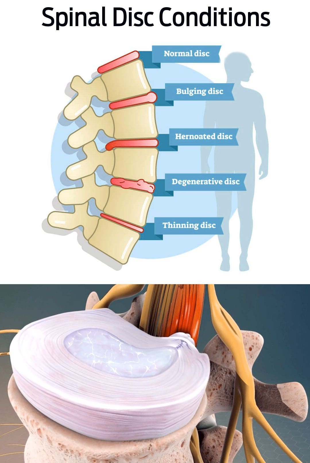 Dolore al disco sporgente: fisioterapisti e sollievo chiropratico