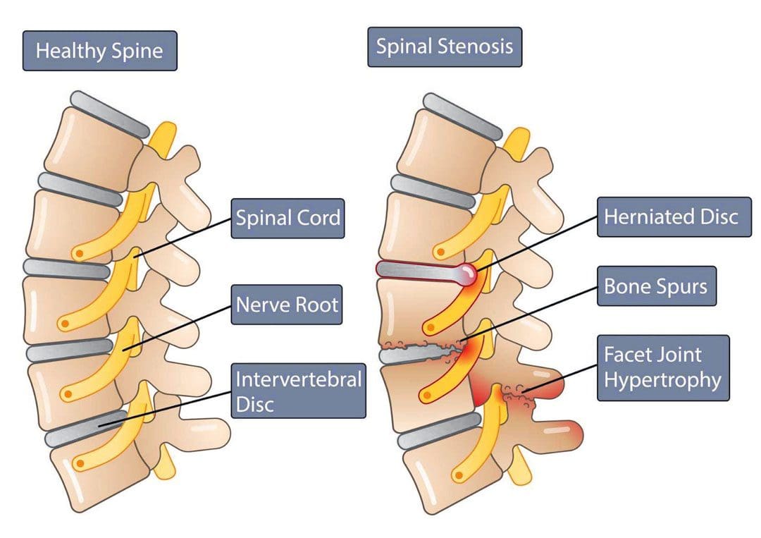 Managing Facet Hypertrophy Pain: A Guide