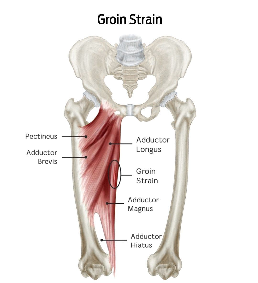 How to Recognize and Treat a Groin Strain Injury