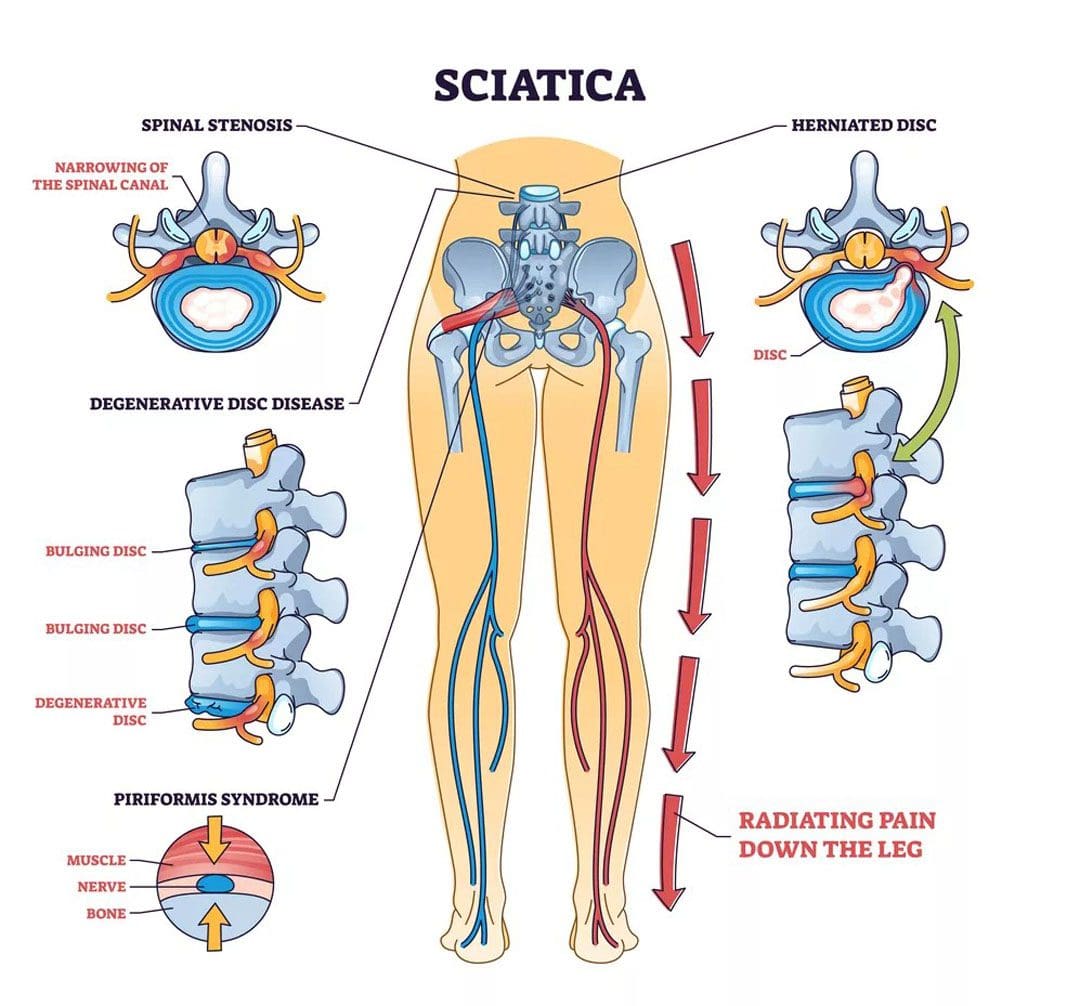 Sciatica avanzata: riconoscere i sintomi del danno ai nervi