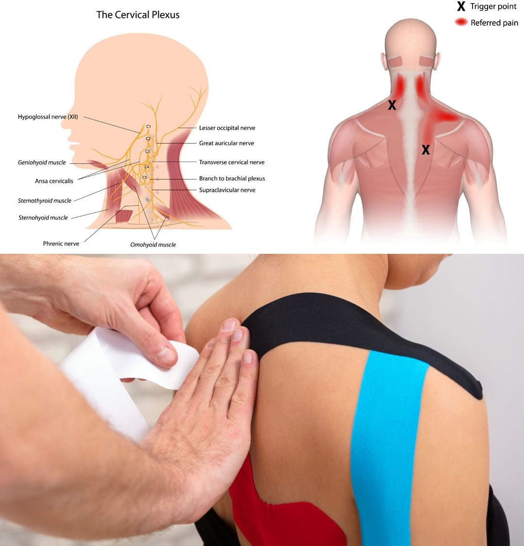 Kinesiology Tape: How to Release Neck & Shoulder Trigger Points