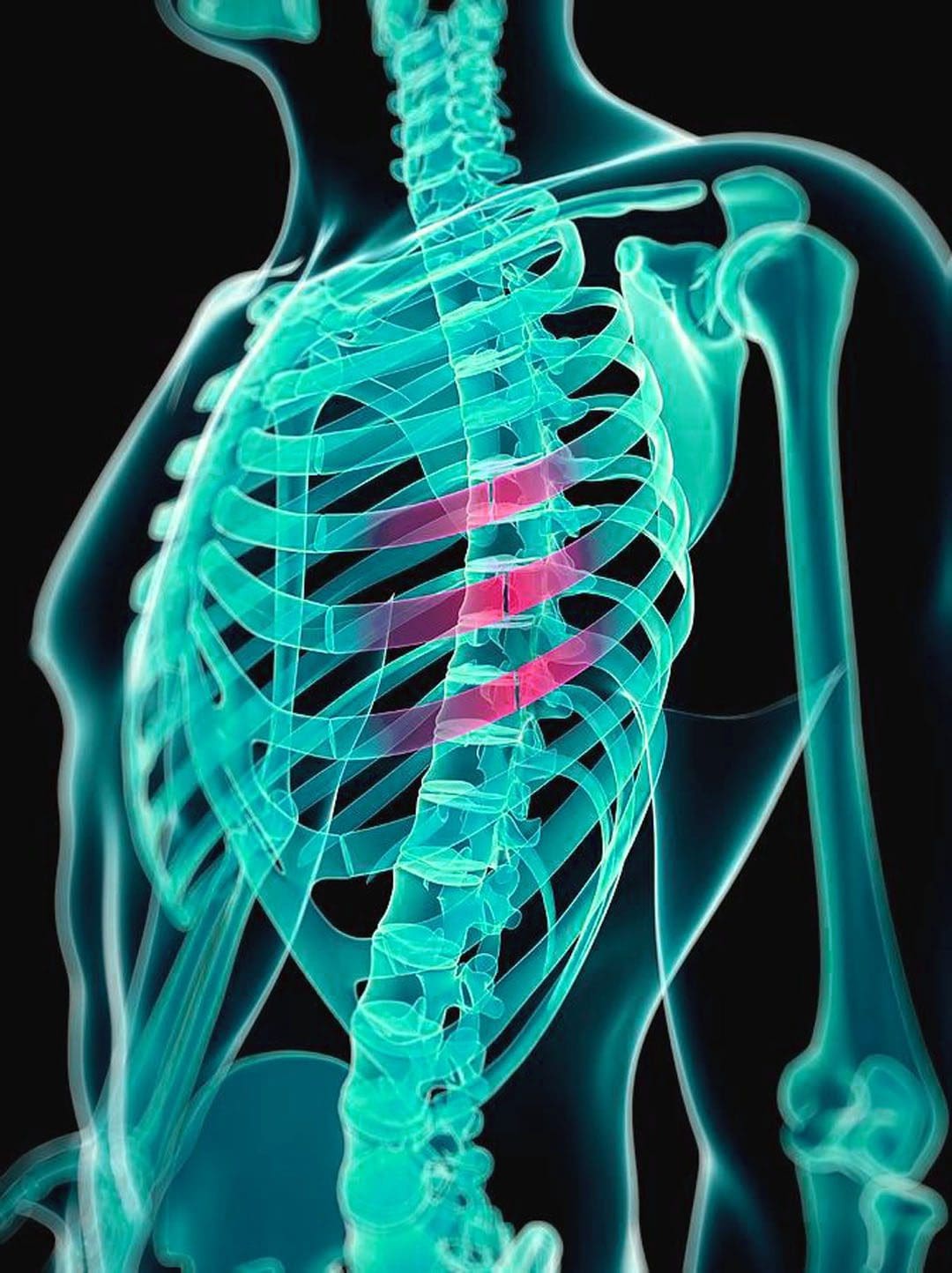 What You Need to Know About Cracked Ribs: Pain and Treatment