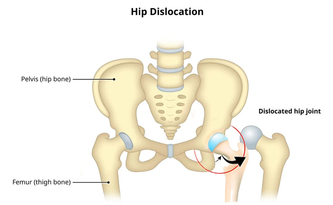 The Complete Guide to Dislocated Hip: Causes and Solutions